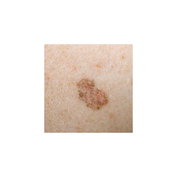 Dermatoscope LuxaScope CCT LED 2.5V Noir - Image 4