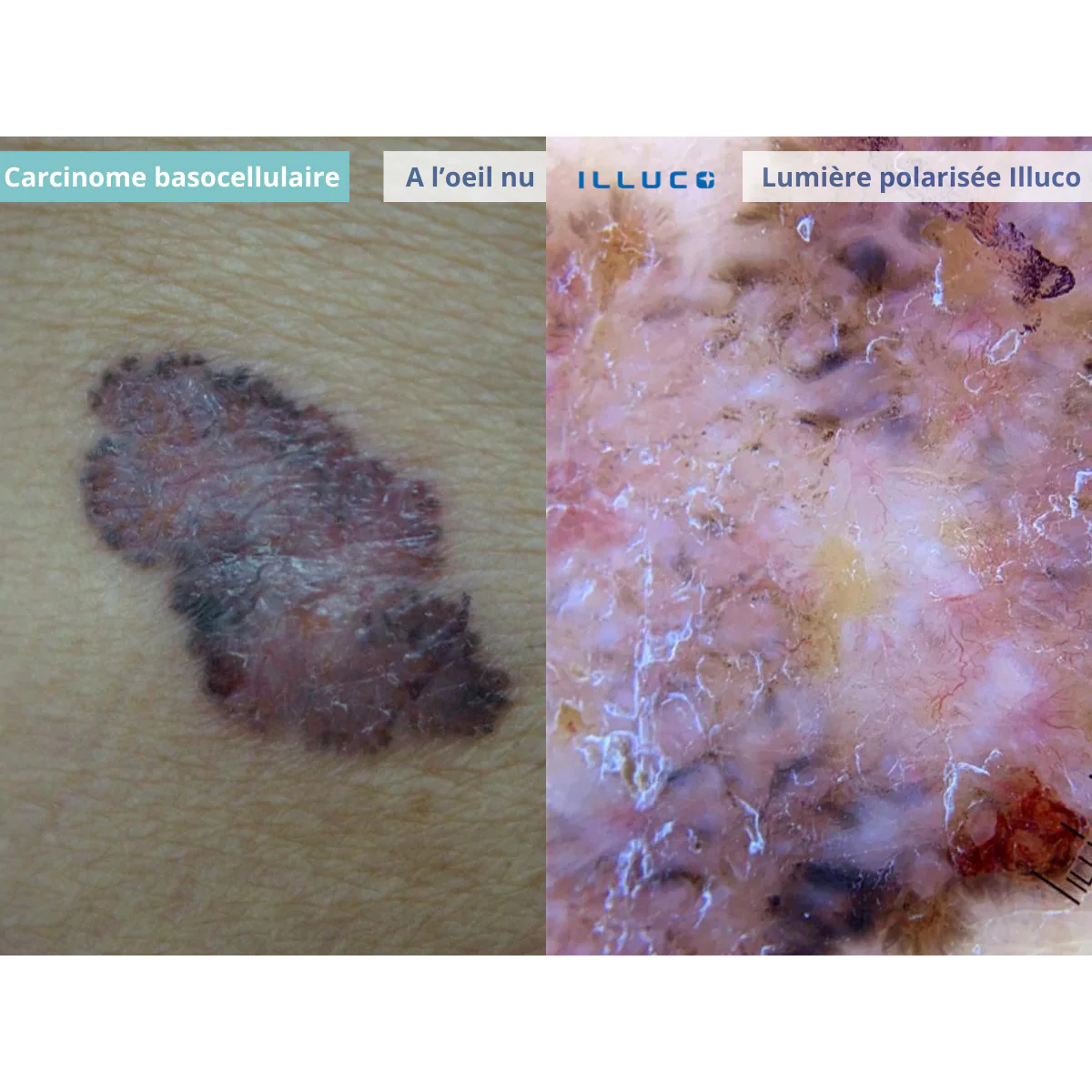 Dermatoscope rechargeable ILLUCO IDS-1100 - Image 7