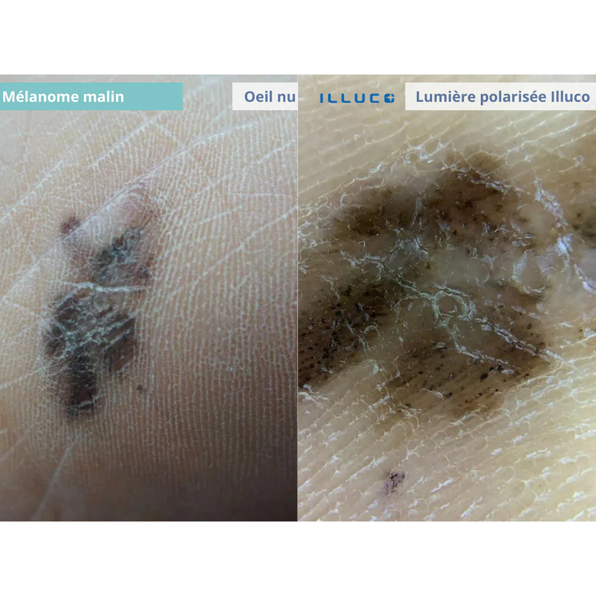 Dermatoscope rechargeable ILLUCO IDS-1100 - Image 9