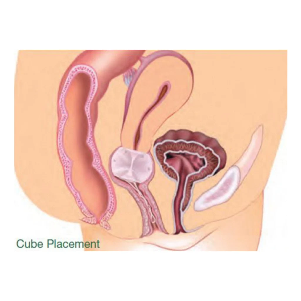 Pessaire silicone Gyn&Cube - GYNEAS - Image 5